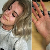 "I'm afraid to open the refrigerator": how a girl with an allergy to cold lives