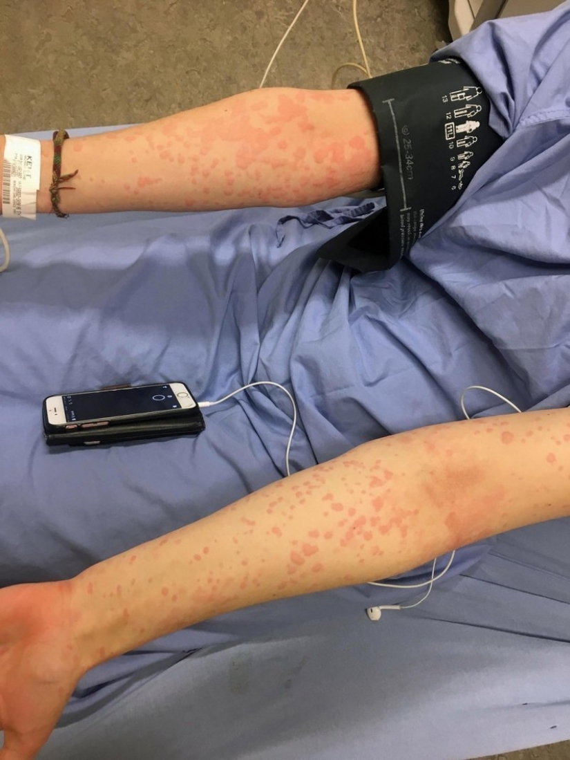 "I'm afraid to open the refrigerator": how a girl with an allergy to cold lives