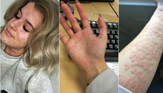 "I'm afraid to open the refrigerator": how a girl with an allergy to cold lives