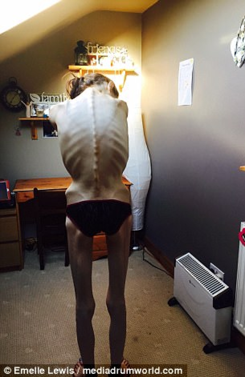 "Instagram saved my life": anorexic woman wanted to live thanks to photos of girls who defeated the disease "Instagram saved my life": anorexic woman wanted to live thanks to photos of girls who defeated the disease