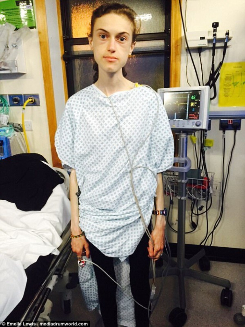 "Instagram saved my life": anorexic woman wanted to live thanks to photos of girls who defeated the disease "Instagram saved my life": anorexic woman wanted to live thanks to photos of girls who defeated the disease