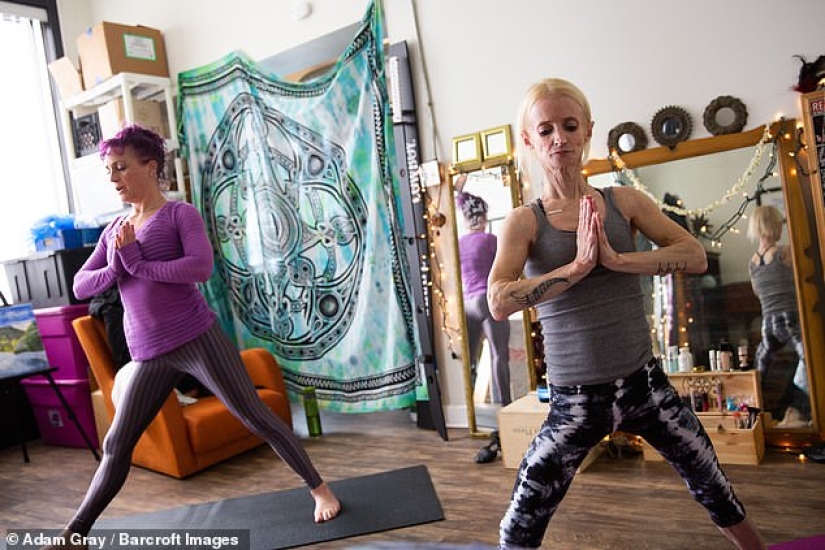 Joven "anciana": una mujer envejece 8 veces más rápido de lo habitual debido al síndrome de "Benjamin Button" Joven "anciana": una mujer envejece 8 veces más rápido de lo habitual debido al síndrome de "Benjamin Button"