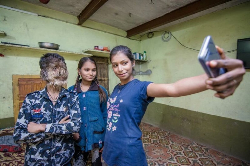 Kind and fluffy: A 13-year-old boy from India suffers from "werewolf syndrome"