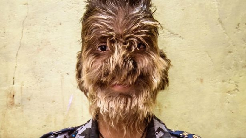Kind and fluffy: A 13-year-old boy from India suffers from "werewolf syndrome"