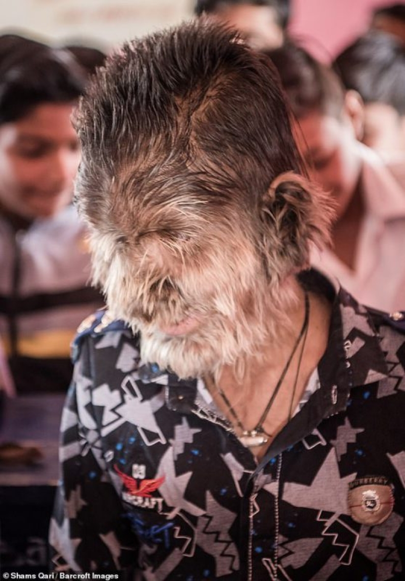 Kind and fluffy: A 13-year-old boy from India suffers from "werewolf syndrome"