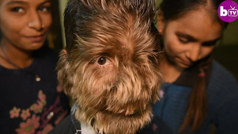 Kind and fluffy: A 13-year-old boy from India suffers from "werewolf syndrome"