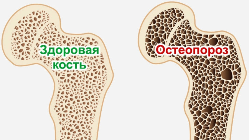 La mujer china "envejeció" 30 años debido al hecho de que amaba mucho el café La mujer china "envejeció" 30 años debido al hecho de que amaba mucho el café