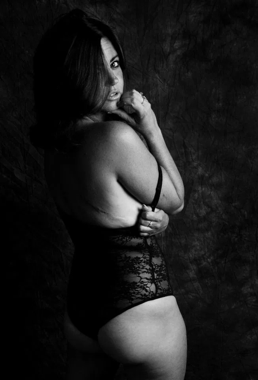 La verdad desnuda: Pacientes valientes se enfrentan al cáncer mostrando cicatrices en el conmovedor proyecto fotográfico de Ami Barwell