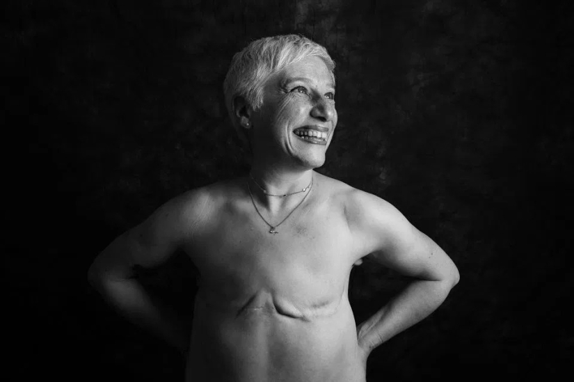 La verdad desnuda: Pacientes valientes se enfrentan al cáncer mostrando cicatrices en el conmovedor proyecto fotográfico de Ami Barwell