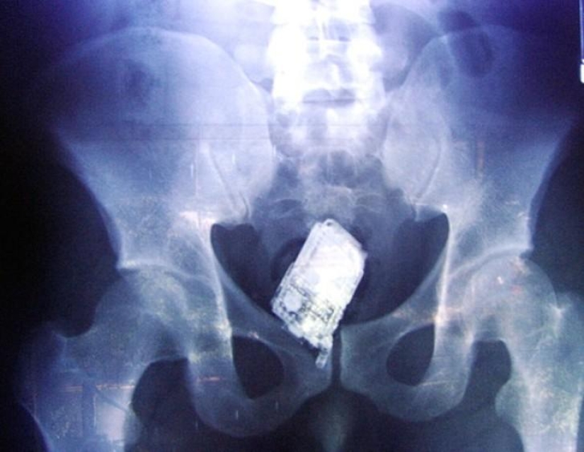 Los objetos más increíbles que se han encontrado en el cuerpo humano