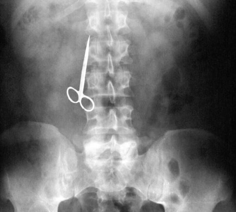 Los objetos más increíbles que se han encontrado en el cuerpo humano