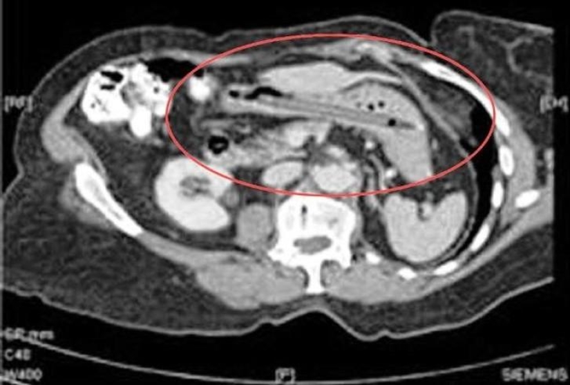 Los objetos más increíbles que se han encontrado en el cuerpo humano