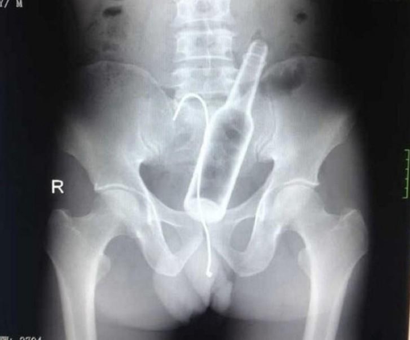 Los objetos más increíbles que se han encontrado en el cuerpo humano