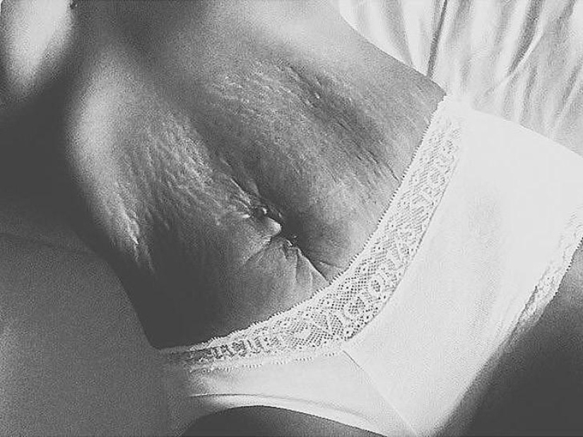 Love your stretch marks Love your stretch marks