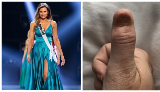 Manicura mortal: la reina de belleza fue diagnosticada con cáncer después de las extensiones de uñas