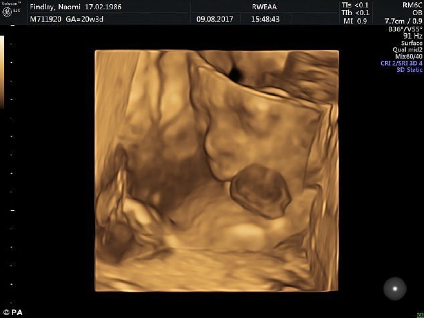 Médicos británicos salvaron a una niña que nació con el corazón fuera