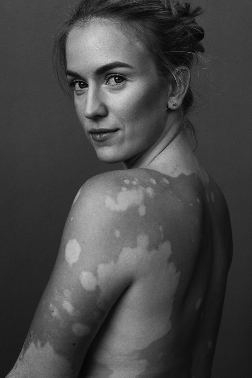 Modelos con vitíligo: hermosas y sorprendentes Modelos con vitíligo: hermosas y sorprendentes