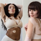 Models with vitiligo: beautiful and amazing