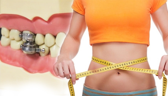 Mouth shut: scientists from New Zealand have come up with an ingenious way to lose weight