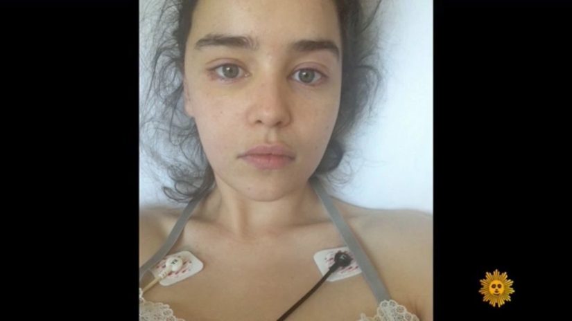 Photos of Emilia Clarke after a stroke and skull trepanation appeared on the web