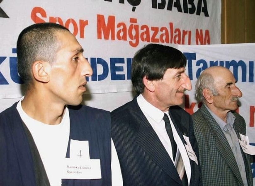 Pinocho en la vida real: el hombre con la nariz más larga del mundo Pinocho en la vida real: el hombre con la nariz más larga del mundo