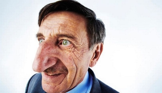 Pinocho en la vida real: el hombre con la nariz más larga del mundo