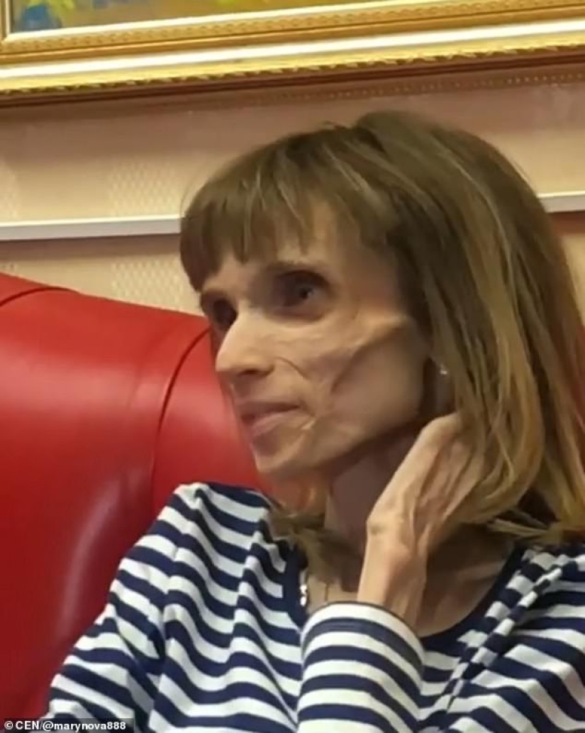 "Podrías interpretar a un cadáver en una película de terror": médico humilló a niña con anorexia