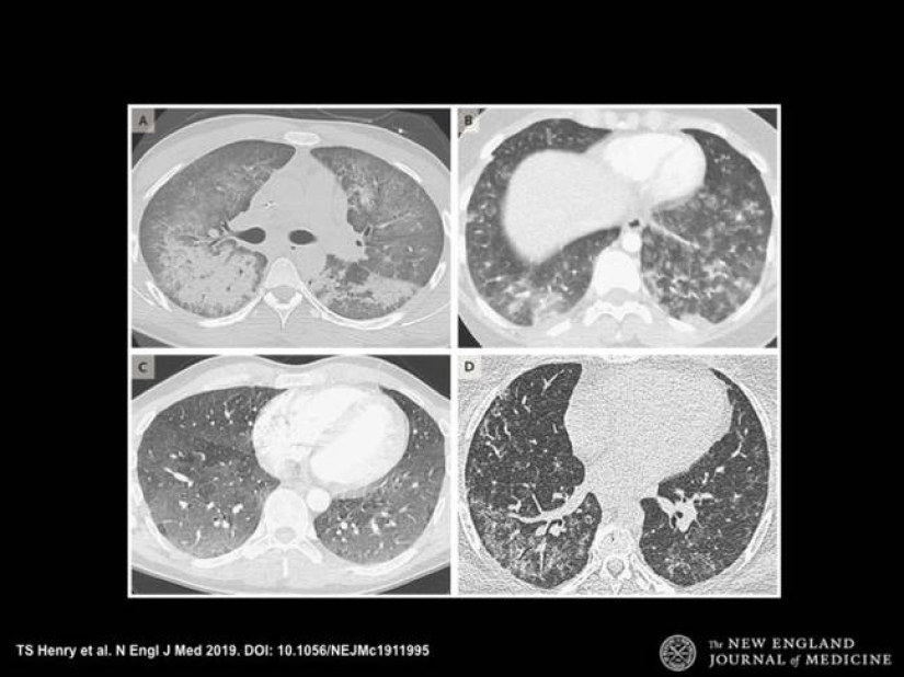 Shocking X-rays of light vapers
