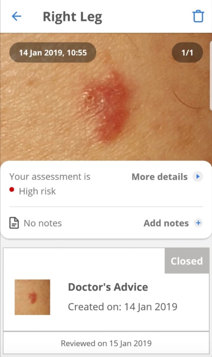 Solar coffin: these women have acquired a nice tan and skin cancer after Solarium Solar coffin: these women have acquired a nice tan and skin cancer after Solarium