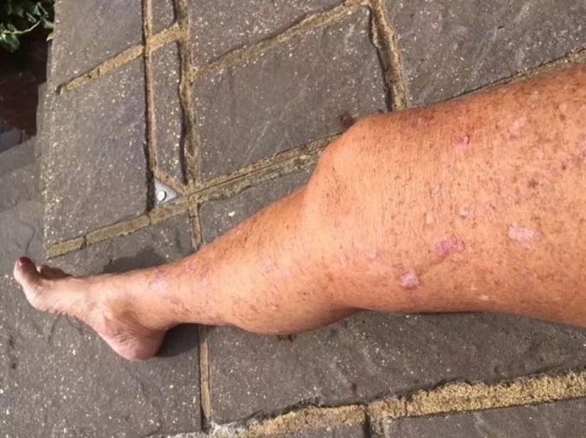 Solar coffin: these women have acquired a nice tan and skin cancer after Solarium Solar coffin: these women have acquired a nice tan and skin cancer after Solarium