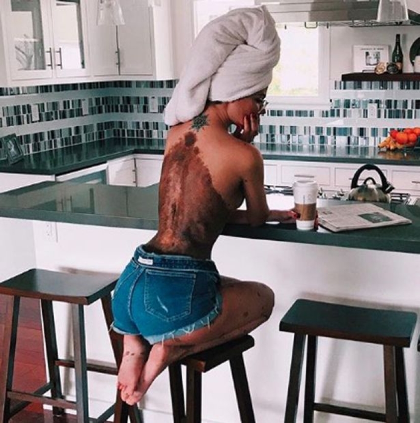 Special signs: because of birthmarks, the girl was nicknamed "Dalmatian", but she considers herself sexy Special signs: because of birthmarks, the girl was nicknamed "Dalmatian", but she considers herself sexy