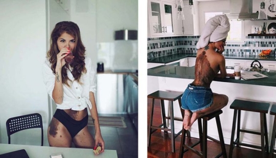 Special signs: because of birthmarks, the girl was nicknamed "Dalmatian", but she considers herself sexy