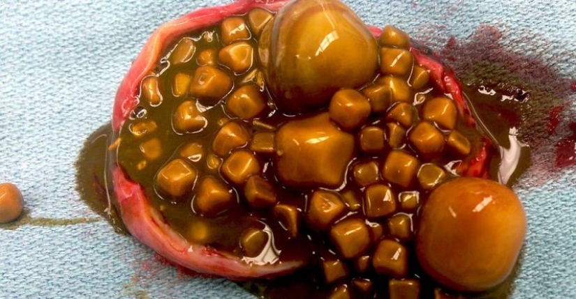 Stone Lady: during the operation, more than 2,000 gallstones were removed from the Chinese woman's gallbladder