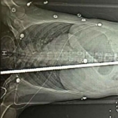 The builder miraculously survived after he was pierced through by a two-meter rebar