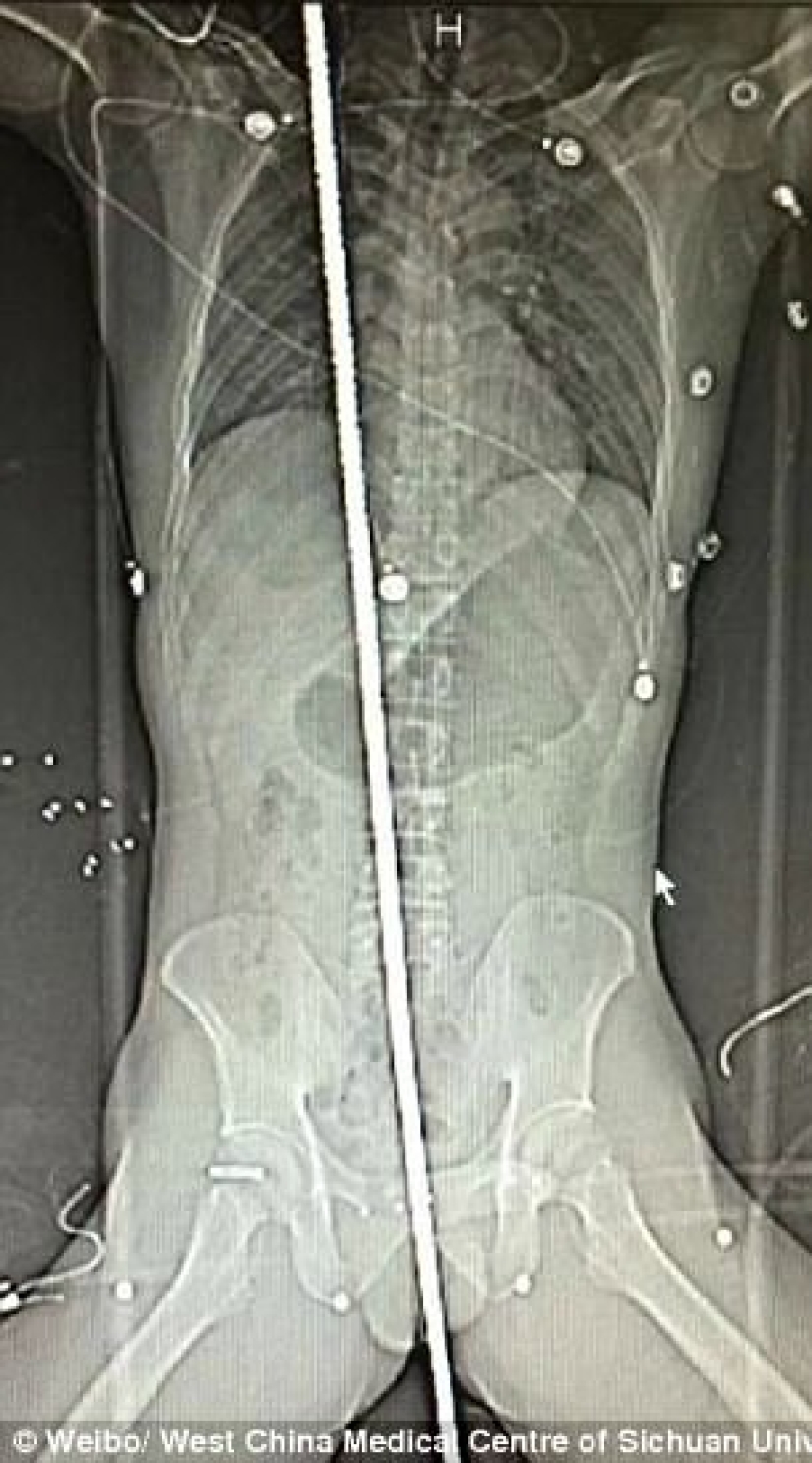 The builder miraculously survived after he was pierced through by a two-meter rebar