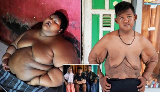 The fattest boy in the world, who weighed 192 kg at the age of 10, lost more than twice as much weight