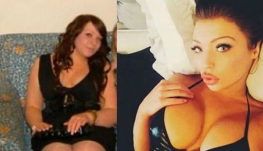 The girl who was teased for being overweight, had plastic surgery for 34 thousand dollars and can't stop