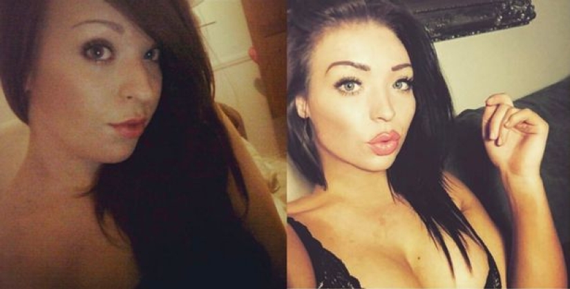 The girl who was teased for being overweight, had plastic surgery for 34 thousand dollars and can't stop