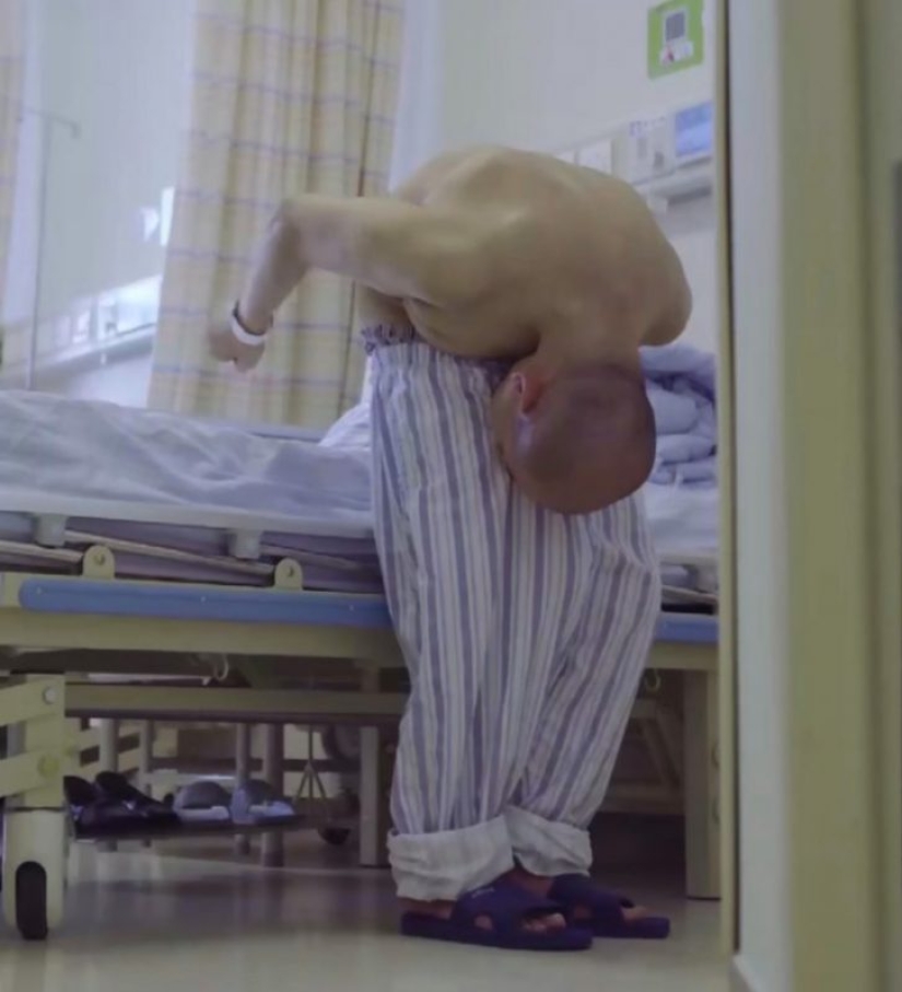 The man lived 28 years folded in half due to a rare disease