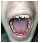 The power engineer who destroyed teeth and life: the 21-year-old guy lost his smile and dreams, regularly drinking an invigorating drink