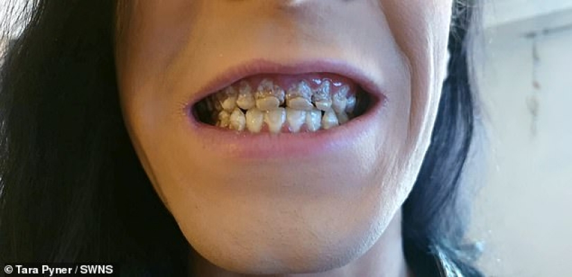 The power engineer who destroyed teeth and life: the 21-year-old guy lost his smile and dreams, regularly drinking an invigorating drink