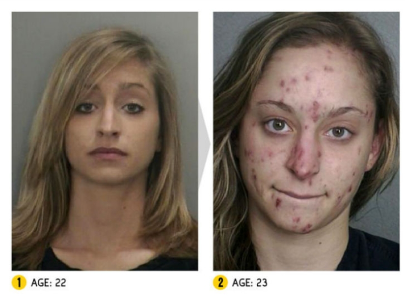 The result is obvious — how a person's appearance changes because of drugs