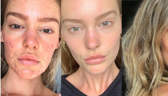 The result is obvious: the Sports Illustrated model got rid of acne, thanks to nutrition and meditation