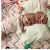 The right to life: 1.5-year-old Siamese twins, born with fused heads, recovered after a complicated operation and rejoice every day