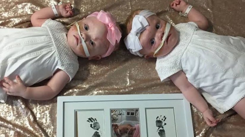 The right to life: 1.5-year-old Siamese twins, born with fused heads, recovered after a complicated operation and rejoice every day