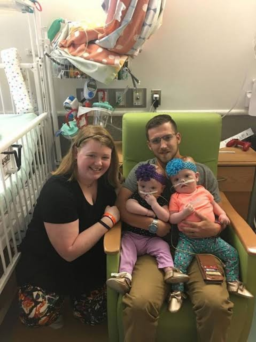 The right to life: 1.5-year-old Siamese twins, born with fused heads, recovered after a complicated operation and rejoice every day