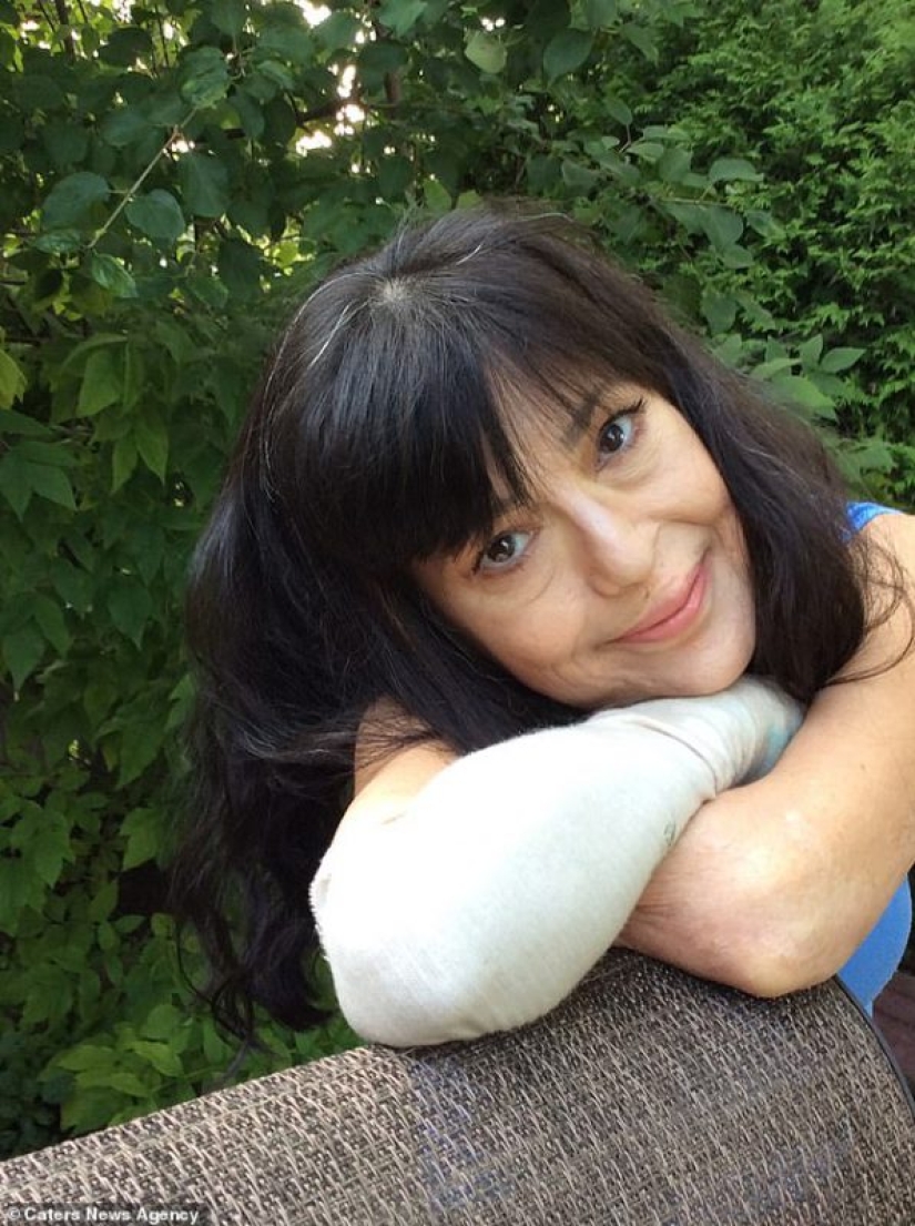 Un juego con final triste: una mujer enfermó de sepsis y se sometió a tres amputaciones después de ser mordida por su amado perro