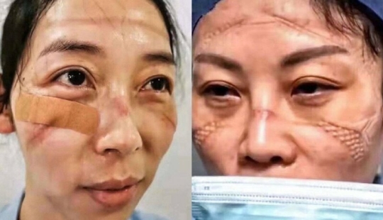 What do the faces of Chinese doctors look like at the end of a work shift What do the faces of Chinese doctors look like at the end of a work shift