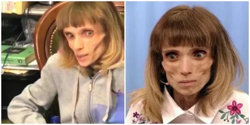 What does Kristina Koryagina look like now — a Russian woman who weighed 17 kg What does Kristina Koryagina look like now — a Russian woman who weighed 17 kg