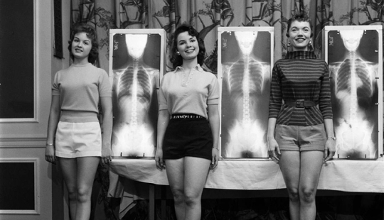 X-ray, plumb line and scales: how to choose "Miss correct posture" in the 50s